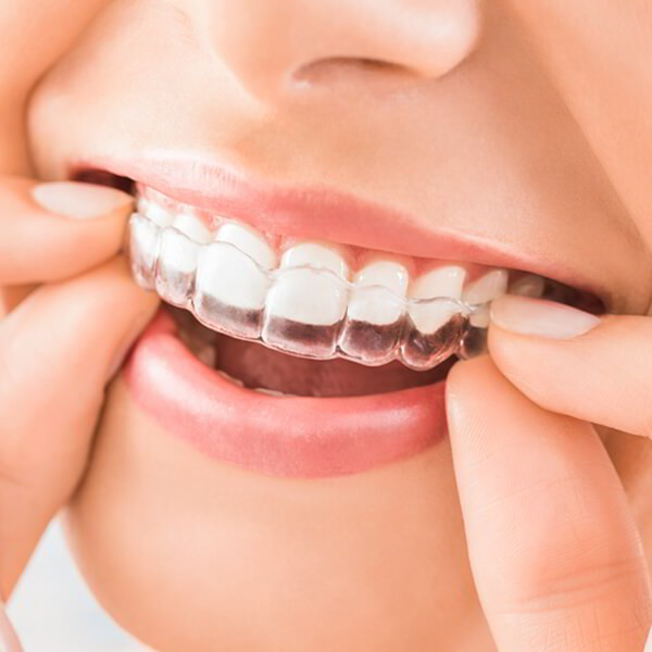 A beautiful smile can change everything. Invisalign is a modern treatment to