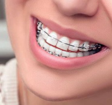 FAQ in Braces treatment