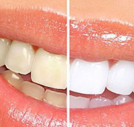 Is laser teeth whitening harmful to your teeth?