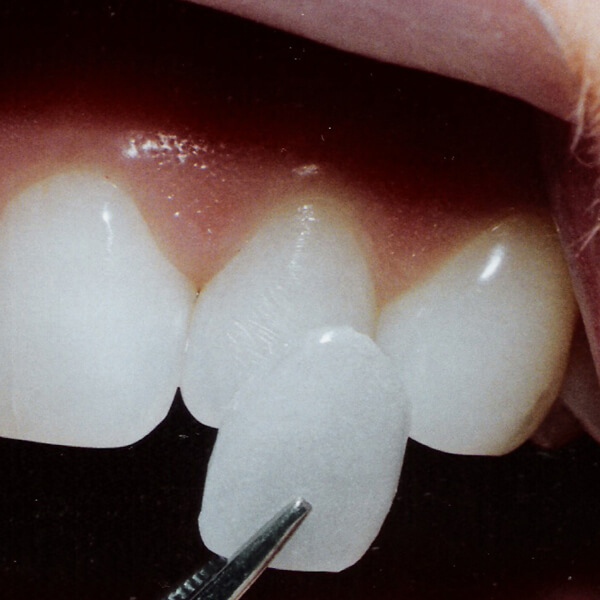 Adjusting teeth and jaw problems not only helps us to change our aesthetics, but also to create the foundation for comprehensive oral health...